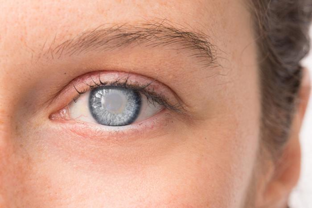 How to Recognize and Treat Cataracts: A Comprehensive Guide