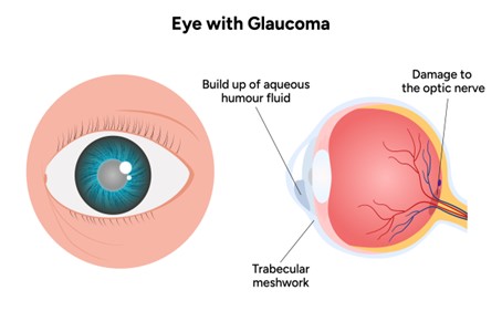 The Hidden Dangers of Glaucoma Complications: What You Need to Know