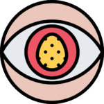 Pterygium